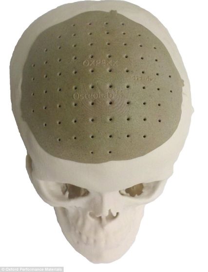 3D打印头骨的制造者、康涅狄格州牛津性能材料公司的研究人员表示，他们希望利用3D打印植入物替换患者其他部位的缺失或者受损骨骼
