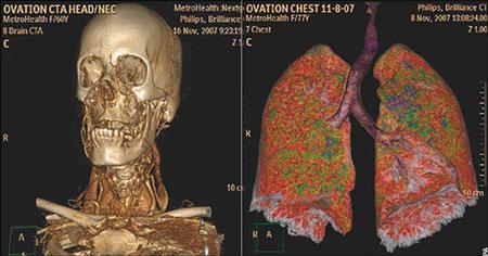 新型CT机可绘制出人体内部构造三维图