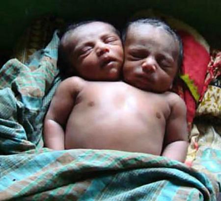 孟加拉国双头男婴吸引15万人观看(图)