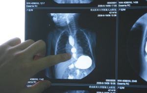 昨日，大坪医院，X光片显示超超食道分成三节本组图片均由本报记者 石涛 摄 
