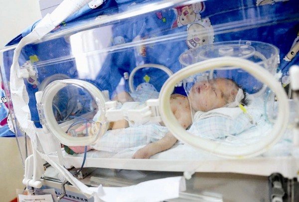 厦门3医院接力救活心脏病宝宝