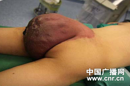 西京医院成功切除国际罕见巨大蔓状血管瘤
