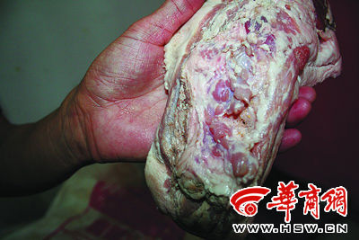甲状腺未摘除干净的“雨润问题肉”