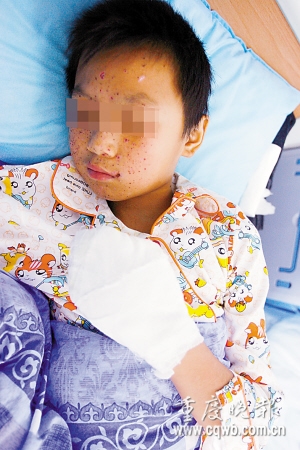 工地上捡"火炮"炸飞男孩六手指