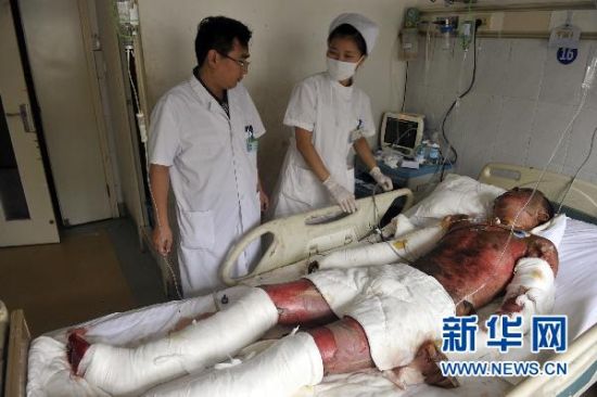 7月22日,驻马店159医院烧伤救治中心医护人员对大客车燃烧事故重伤