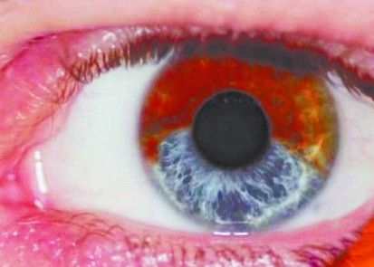 医学专家研发一激光疗法 眼睛变蓝色仅需20秒