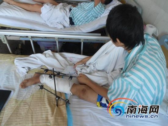 我有个朋友车祸导致大腿骨折手术钢板固定后3个月再次