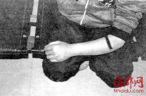 “碰瓷党”买少年断其手臂“撞车”诈钱