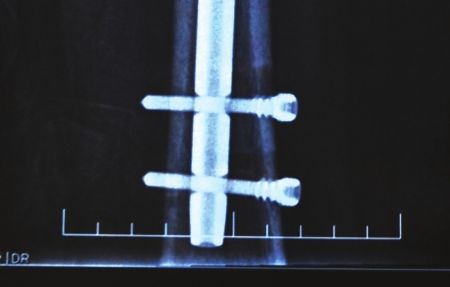骨折手术出院3月后 x光片显示:固定钢板没固定