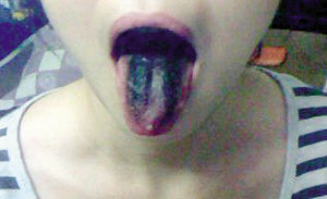 夫妻俩烫火锅舌头吃黑了