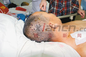 山区胡蜂致多人身亡 安康一家医院申报治蜂蜇