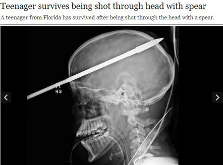 美国一少年被鱼枪贯穿右脑后幸存 有望完全康复(图)