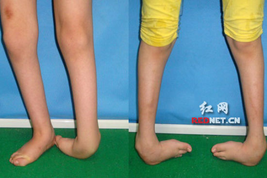 湖南两个马蹄内翻足女孩期盼爱心人士救助(图)