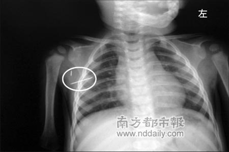 10个月大女婴胸中检查出钢针(组图)