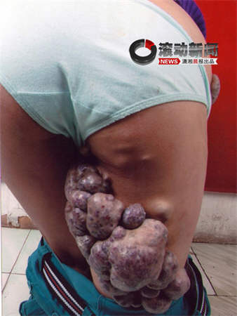 女大学生患血管瘤病血疱超8斤(图)