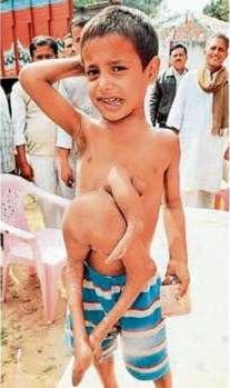 印度8岁连体男孩腹部长出双腿和手臂(图)