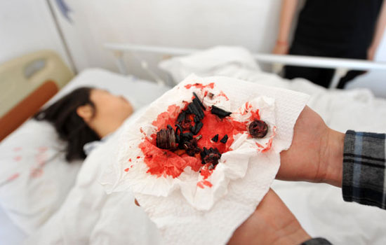 座椅爆炸致女子被炸伤大量碎片嵌入身体(组图)