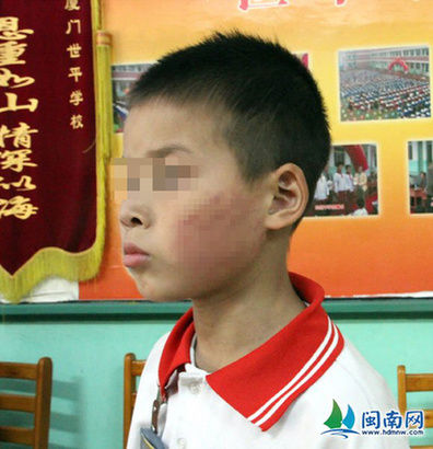 小赖分成一组打耳光的小陈同学，左脸颊留有红红的巴掌印。