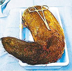 医生让这名少女接连5天服用普通的食物