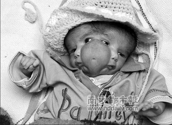 印度降生 双面女婴 _新闻中心