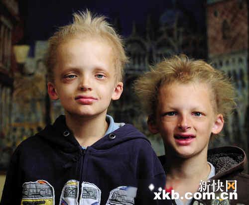 现实版吸血鬼!发育不良惹的祸