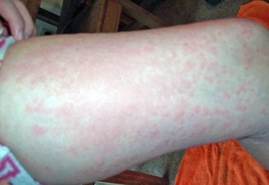 由于突患冷空气过敏性荨麻疹,阿比在过去的5个月里,只能待在室内