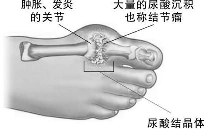 顽固痛风5个月可停药