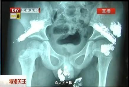 昆明5岁男童体内突然出现大量水银物质