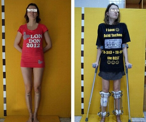 为了模特梦 俄罗斯30岁女断骨增高变身长腿模特