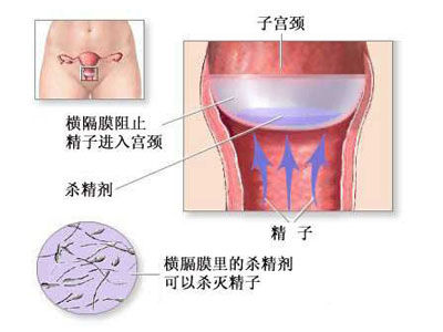 宫颈帽的避孕机制