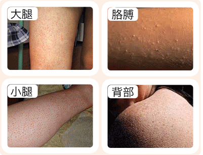 解决"鸡皮肤" 还原平滑肌肤|整形|鸡皮肤|毛囊_新浪女性_新浪网