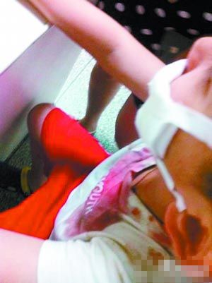 罐装可乐冷冻后开启爆炸 男孩脸被炸伤(图)