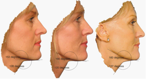 　图1.侧面测量：颈颏角、下颌角不同阶段的角度(术前、术后早期、术后长期)