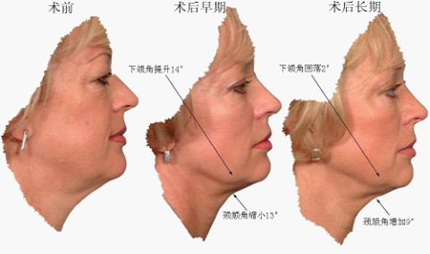 图3：5.5年间的面部变化(侧面观)