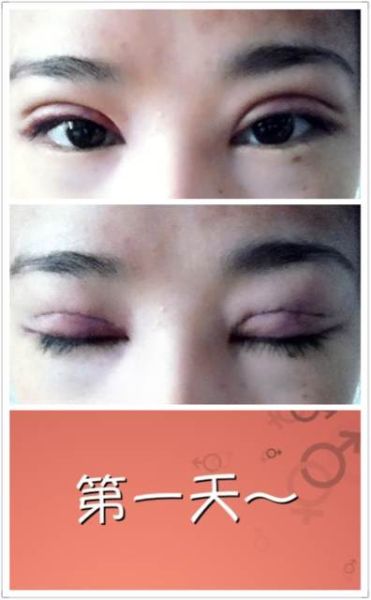 单眼皮mm大翻身+双眼皮手术过程全纪录