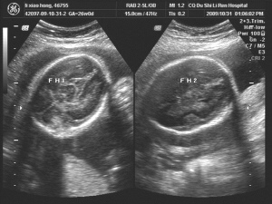 怀孕b超单图片 两个月图片
