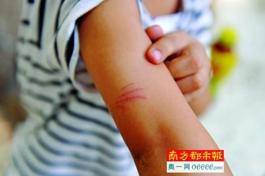 7岁男童餐馆被老鼠抓伤被迫打狂犬疫苗