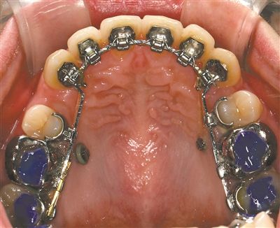 为何钢箍牙儿童越来越多