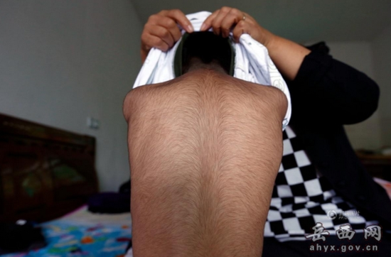 6岁男童患怪病 体重30斤全身长满黑毛