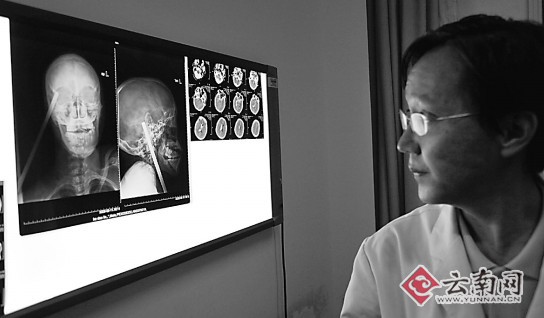 手术前,医生研究取出钢筋的方案 记者 江洋 摄昆明再现钢筋扎人事故!