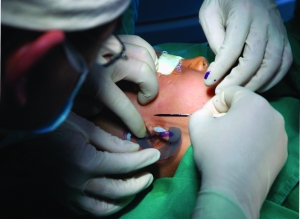 全区首例耳朵再造手术成功