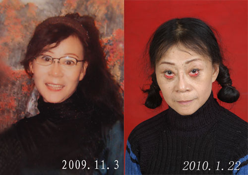 [图]花费万元除皱整容 谁料术后眼睑外翻吓人