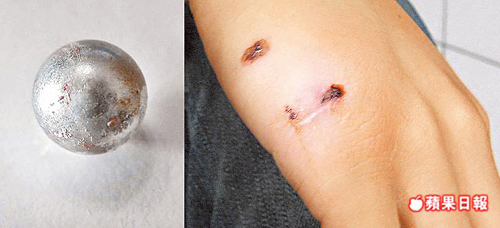 吴姓少年的右手小指近手掌处,也惨遭钢珠弹(左图)射伤.