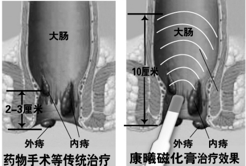 无需用药 也能根治痔疮