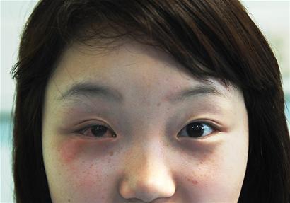 烟花飞到眼前炸 她美丽的眼睛,毁了