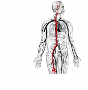 到达大脑主动脉的闭塞部位,注入干细胞,脑内会长出血管侧支的小循环