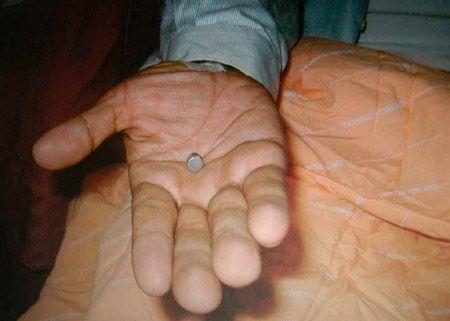 奇美医院在急救后,于陈水扁的后背部找到的圆锥型,似子弹的金属.