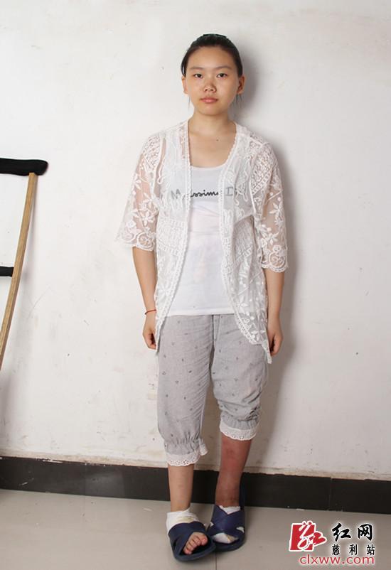 慈利县"巨脚"女孩张迪用笑容坚强逆生