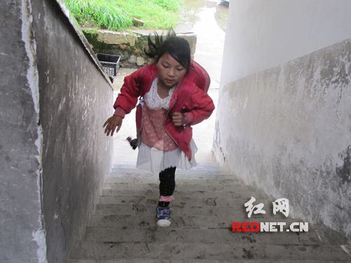 2岁时遭遇车祸失去右腿湘乡9岁独腿女孩将来想当医生