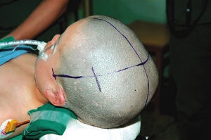 南京完成我国首例儿童巨颅症缩颅手术